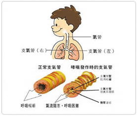 哮喘是由什么原因引起的